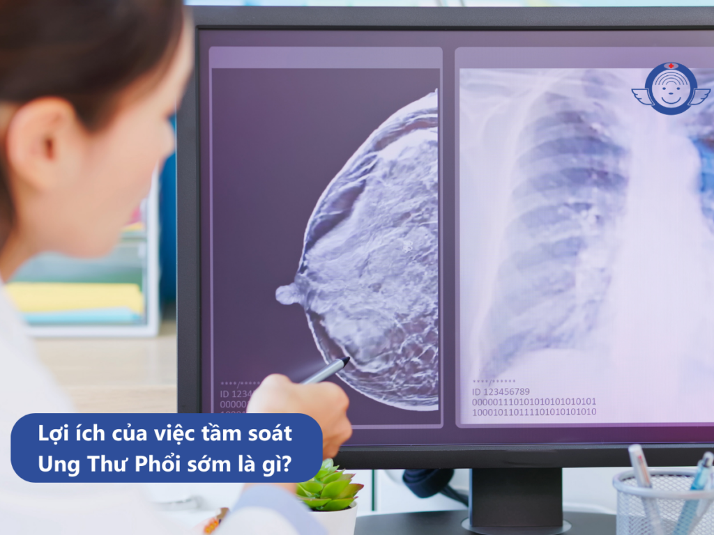 LỢI ÍCH CỦA VIỆC TẦM SOÁT UNG THƯ PHỔI SỚM LÀ GÌ?